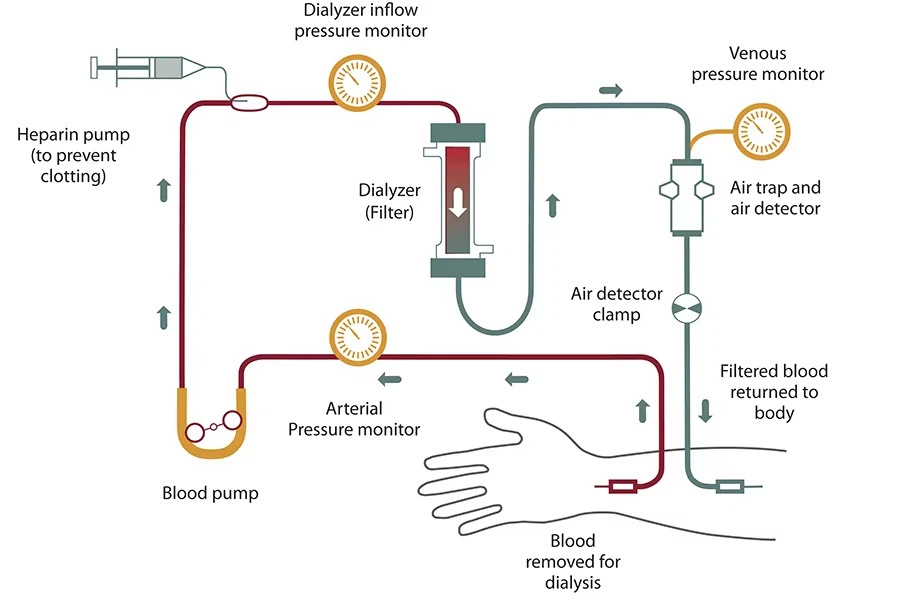 Hemodialysis Hemodialysis